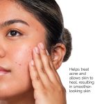 The Acne Set-Regular - Image 4